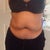 Pre op front view