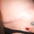 11 weeks post-op
