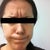Before botox, in the clinic.