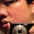 August 28, 2012 - A month after second procedure

Right side of my face reflected in a mirror.