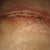 this is my scar opening was at dr yesterday says its normal and he will fix it later