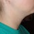 2 Weeks Post - Right Side