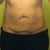Front Tummy Pre Op