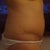 The scar on the side. Amazing profile when you look from the side and see no bulge!! :))))