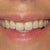 Lips 4 years after Restylane, upper lip still deformed.