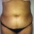 1 week before surgery