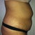 1 week before surgery