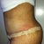 day 5 post op