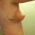 Post Op Day 10