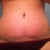Day 10 PO - Nighttime pic close up of belly button and steristrips.