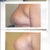 Implants
