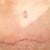 4 weeks scar after 2 weeks biocorneum scar treatment