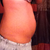 Pre-Op Photo2