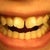 Open mouth. Here you can kinda see my bottom teeth are worn down and my front teeth have chips.
