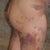 mommy makeover post op flanks