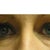 lower eyelids before