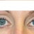 lower eyelids after