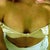 3rd Day Post-Opt. Cleavage line starting to appear! Still swollen between and "squishy" feeling but getting better.