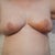Three weeks post op.