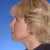 Dr photo after face lift, fat transfer, dermabrasion and brow lift - unretouched