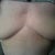 this is day four after explant  left side was the side that deflated and looks a little better than the right