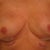 1st day  post-op immidiately after bra removed.  They looked a bit saggier after a 10 min. shower with no bra.