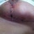 Left boob post op 13 days red mark up by the nipple is where a little stitch is sticking out.