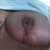 Left post op 13 days