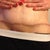 Scar 6 months post op