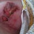 deteriorating wound