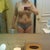 3 days post-op, front view, no gauze