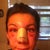 So swollen...2 days after surgery
