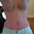 10 weeks post op. No saggy tummy. I'm very happy!