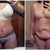 Before Surgery & Two Weeks Post OP