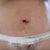 Belly Button - P.O. Day 9