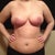 Day 15 post op. redness from possible infection and/or possible allergic reaction to steri strips??