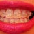 The coloring is off in this photo, but see I am not crazy the teeth are still bunched up after 1-1/2 yrs of Invisalign so this is day one of Ceramic Braces.