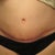 Scar close up 6 Weeks PO