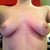 Front  view pre-op