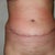 After healing from 1st TT. The swelling area along the top of the scar isnt swelling. It was actually a ring of fat he left. I look like I had a spare tire wrapped around me. The BB area if you look closer was pushed in and the area around it looked swollen. But this is 1 yr Post OP.