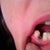 Implant showing through the gum- NOT supposed to look like this!