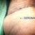 PO Day 13 - Seroma developed. Tennis ball size.  Removed 130CC fluid.