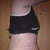 Day 10 Post Op - very swollen in my lower stomach.