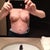 Three days post op
