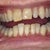 Incisal edges October 2012 Before Treatment