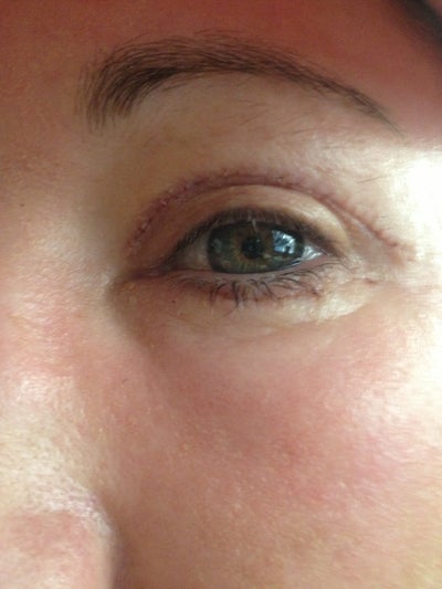 Swelling After Upper and Lower Eyelid Surgery - Winter Park, FL ...